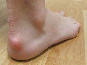 Fersenbein Angeschwollen Normal Gesundheit Und Medizin Sport Medizin Fersenbein Angeschwollen Normal Gesundheit Und Medizin Sport Medizin