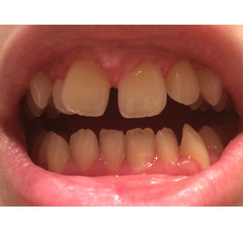 Zähne - (Gesundheit, Zähne, Zahnspange)