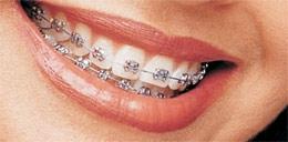 silber - (Zahnarzt, Zahnspange)