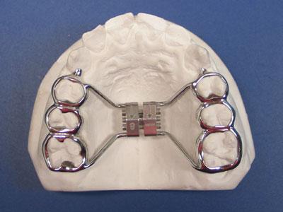 Feste Zahnspange (Gaumenbogen) und schmerz an der zunge (Schmerzen