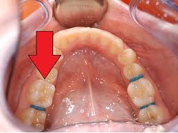 Feste Zahnspange Vorgummis Was Soll Ich Machen Essen Schmerzen Zahne