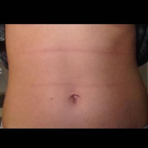 Fett Falten Am Bauch Gesundheit Korper Fett Falten Am Bauch Gesundheit Korper