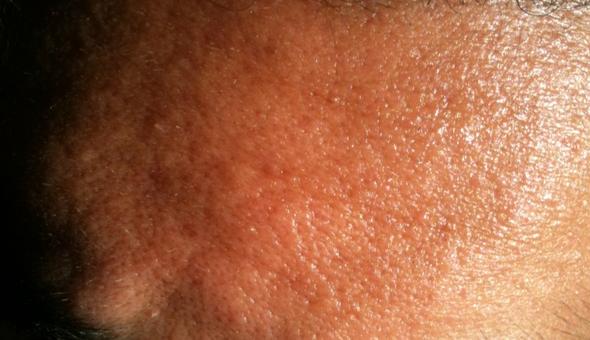 Stirn - (Haut, Hautpflege, Hautprobleme)