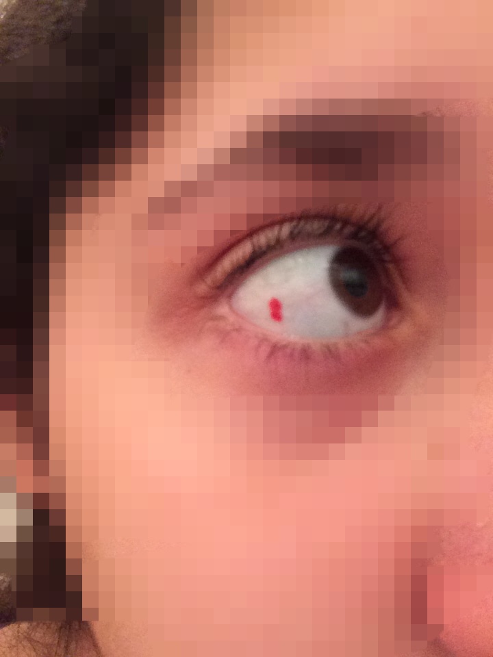 Filzstift im Auge (Augen)