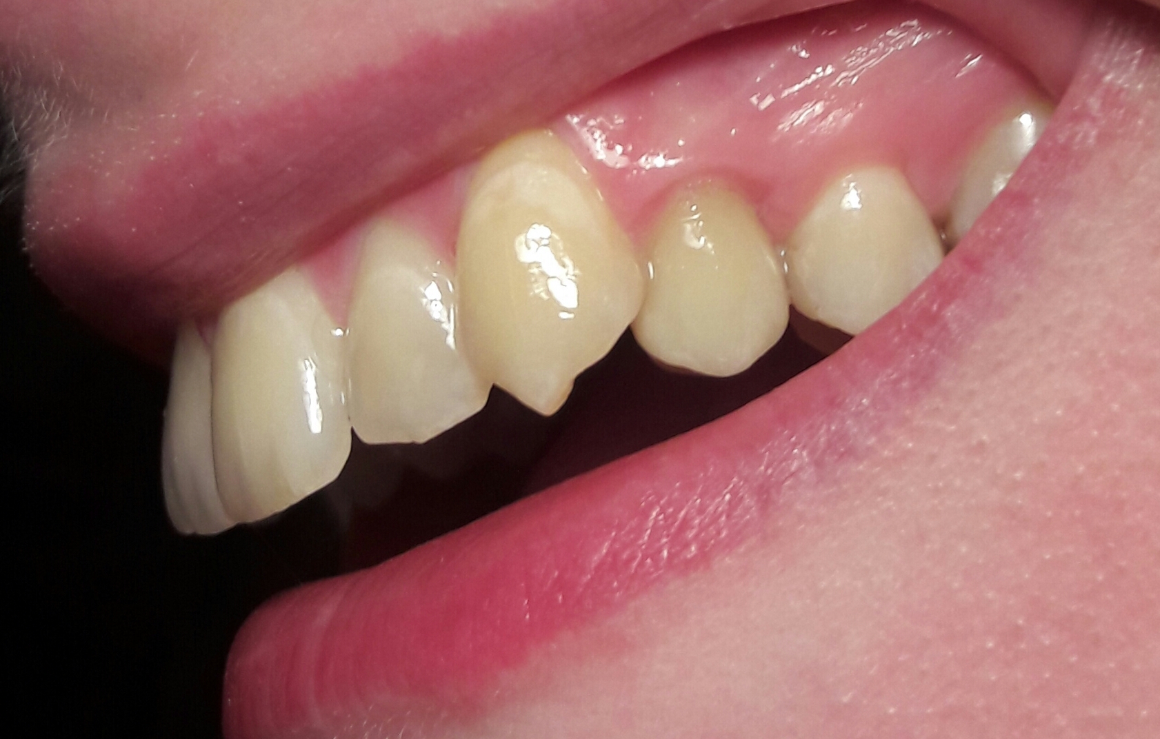 Finden Sie diese Zahnkrone optisch akzeptabel? (Zähne)