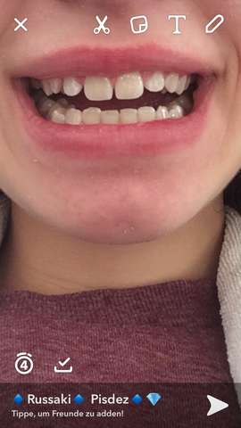 Schneidezähnen zwischen den grosse zahnlücke Zahnlücke??