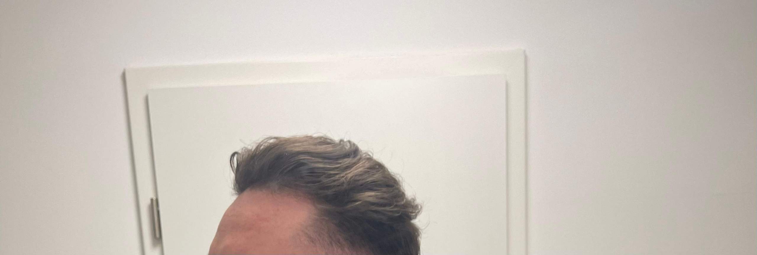 Findet ihr das sind Geheimratsecken? Plötzlich nach tragen von locken ...