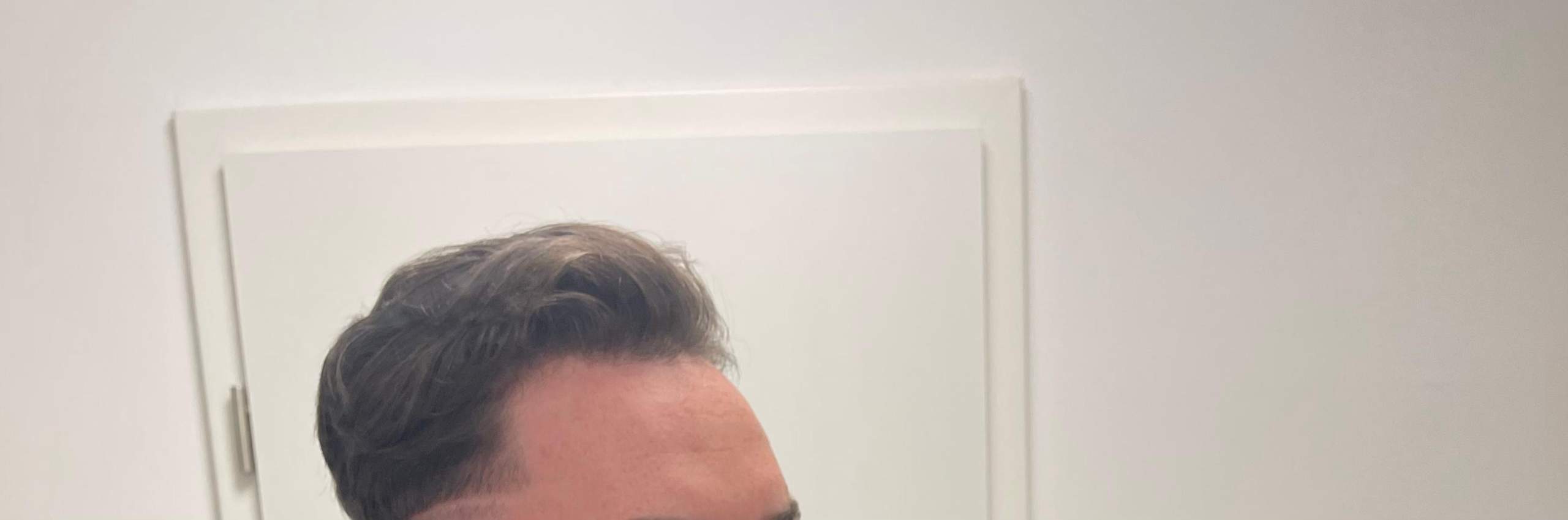 Findet ihr das sind Geheimratsecken? Plötzlich nach tragen von locken ...