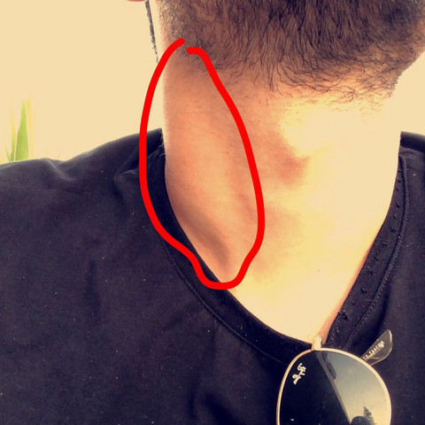 Findet Ihr Dass Diese Schwellung Normal Ist Gesundheit Und Medizin Hals Findet Ihr Dass Diese Schwellung Normal Ist Gesundheit Und Medizin Hals