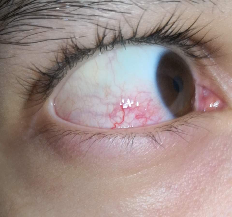 Findet Ihr Meine Augen Gelb Gesundheit Rote Augen Gelbe Augen Findet Ihr Meine Augen Gelb Gesundheit Rote Augen Gelbe Augen