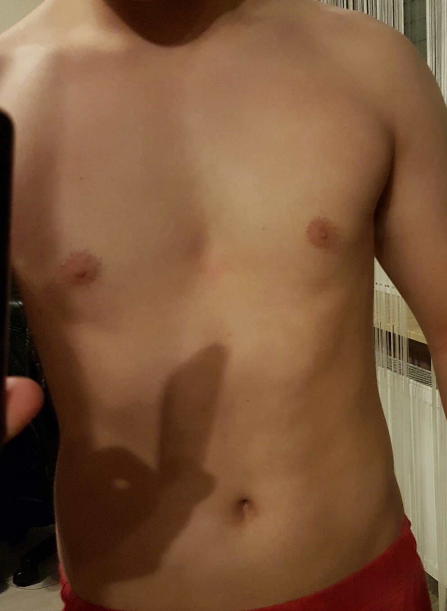 Findet Ihr Meine Trichterbrust Sieht Schlimm Aus Oder Ganz Normal Gesundheit Korper Brust