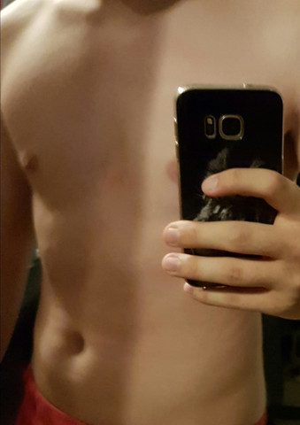 Findet Ihr Meine Trichterbrust Sieht Schlimm Aus Oder Ganz Normal Gesundheit Korper Brust