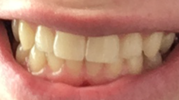 Zähne - (Zähne, Kosmetik)