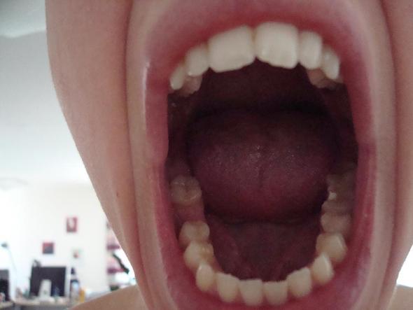 zahnlücke - (Zähne, Lücke, Zahnprothese)
