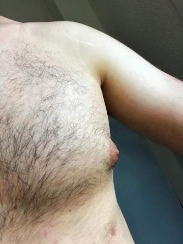 findet ihr solche spitzen brustwarzen schlimm beim mann bild von gynakomastie frauen korper manner