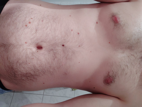 Findet Ihr Viele Muttermale Unschon Bzw Hasslich Gesundheit Schonheit Bauch Findet Ihr Viele Muttermale Unschon Bzw Hasslich Gesundheit Schonheit Bauch