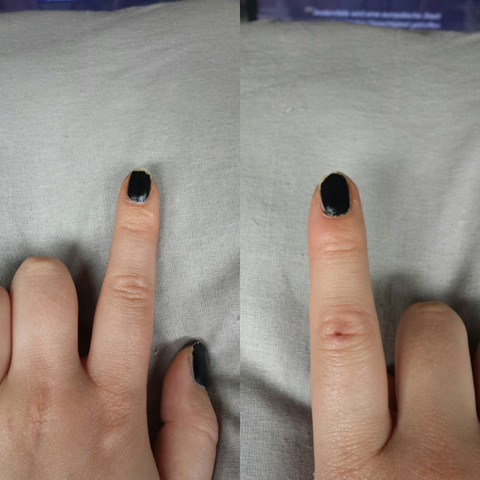 links normal, rechts angeschwollen  - (Finger, angeschwollen)