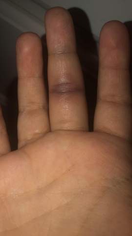 Finger Auf Einmal Dick Und Blau Gesundheit Und Medizin Finger Auf Einmal Dick Und Blau Gesundheit Und Medizin