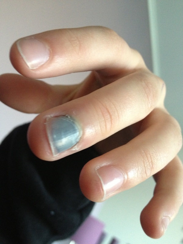 Finger blau& total fett angeschwollen (Arzt)