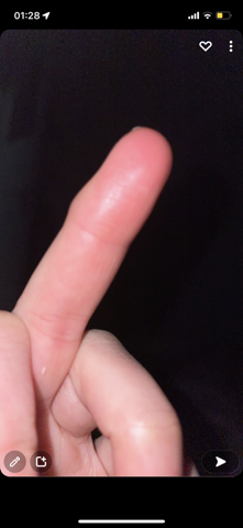 Finger dick? Beule?