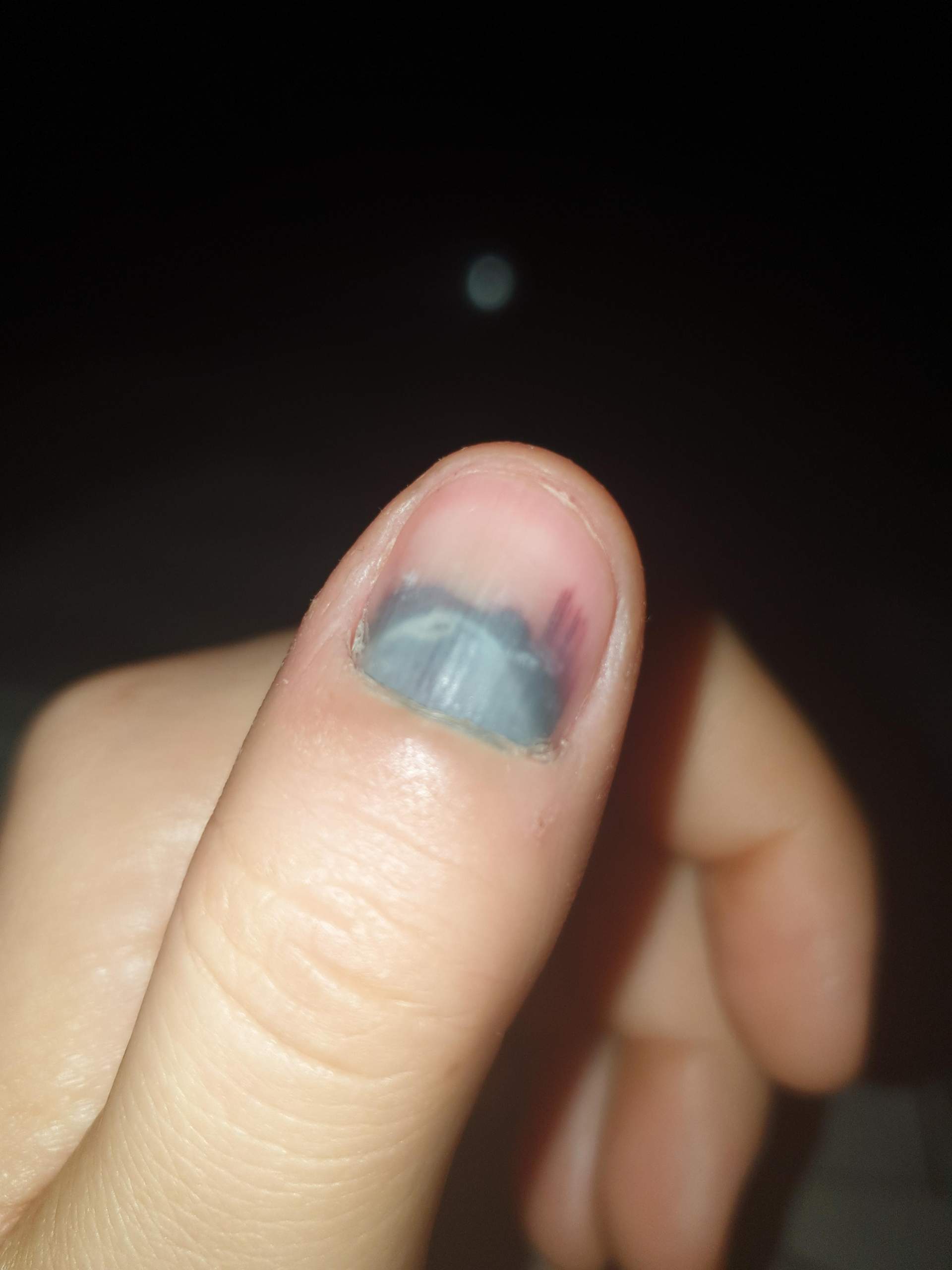 Finger eingeklemmt bei einer Autotür, was soll ich tun gegen Schmerzen? (Gesundheit und Medizin)