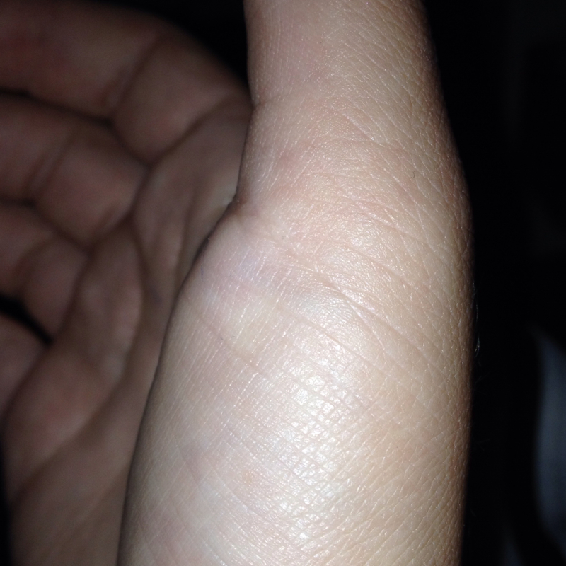 Finger eingeklemmt. Daumen (Hand)