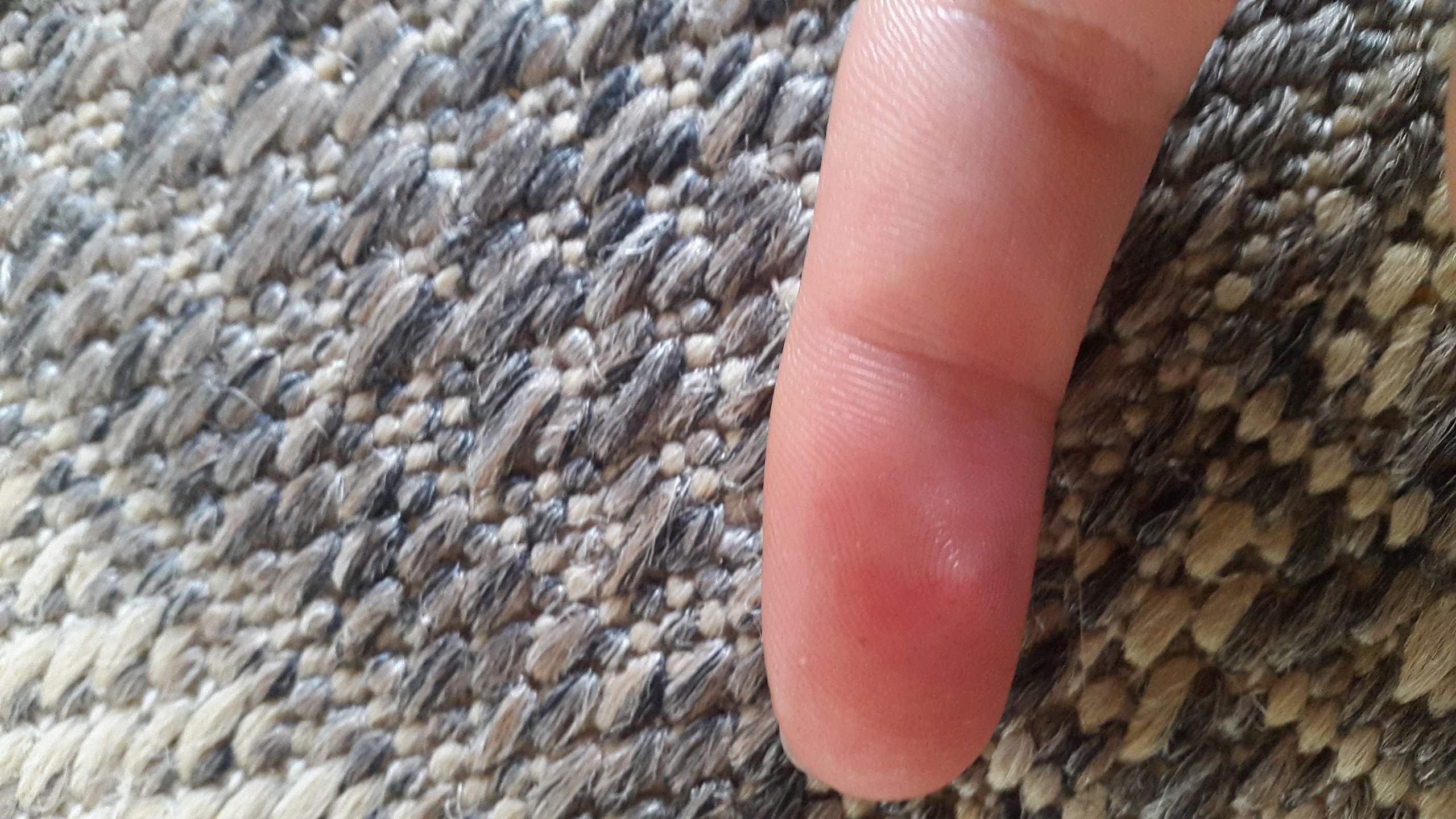 Finger eingeklemmt in Tür was tub? (Gesundheit und Medizin, Gesundheit)