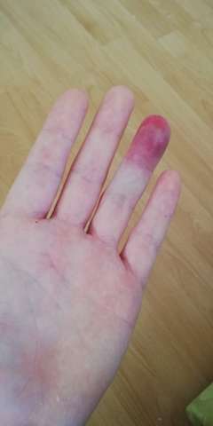 Finger Eingeklemmt Sollte Ich Zum Arzt Bluterguss Finger Eingeklemmt Sollte Ich Zum Arzt Bluterguss