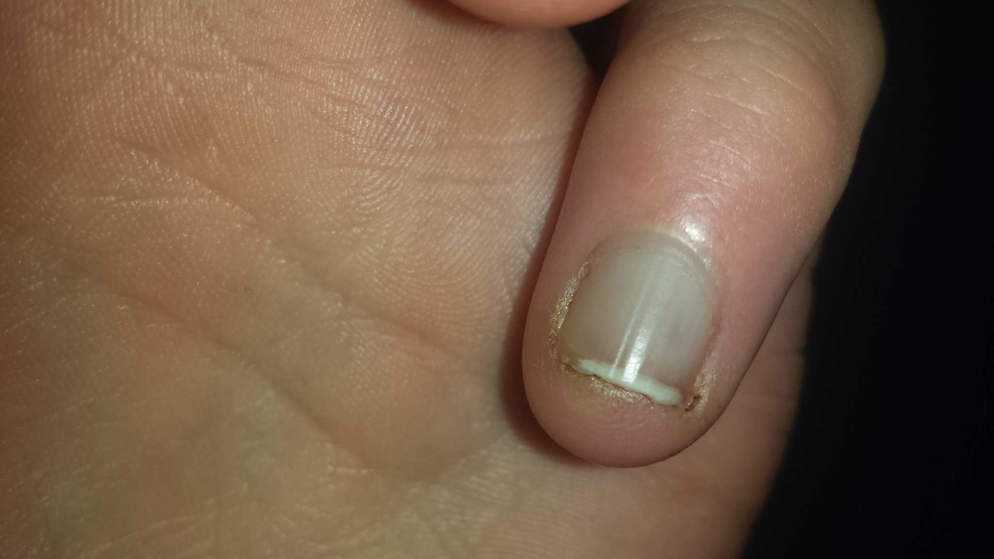 Eiter Im Finger Was Tun - mobinspire
