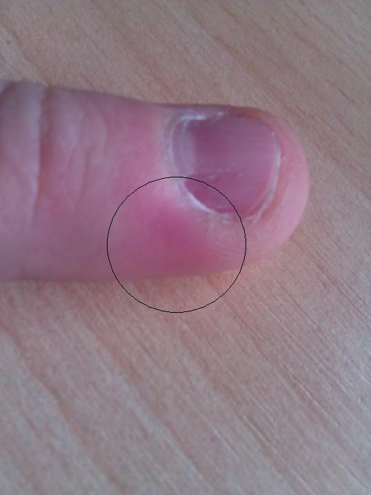 Finger entzündet- Was tun? (Siehe Foto) (Gesundheit, Entzündung)
