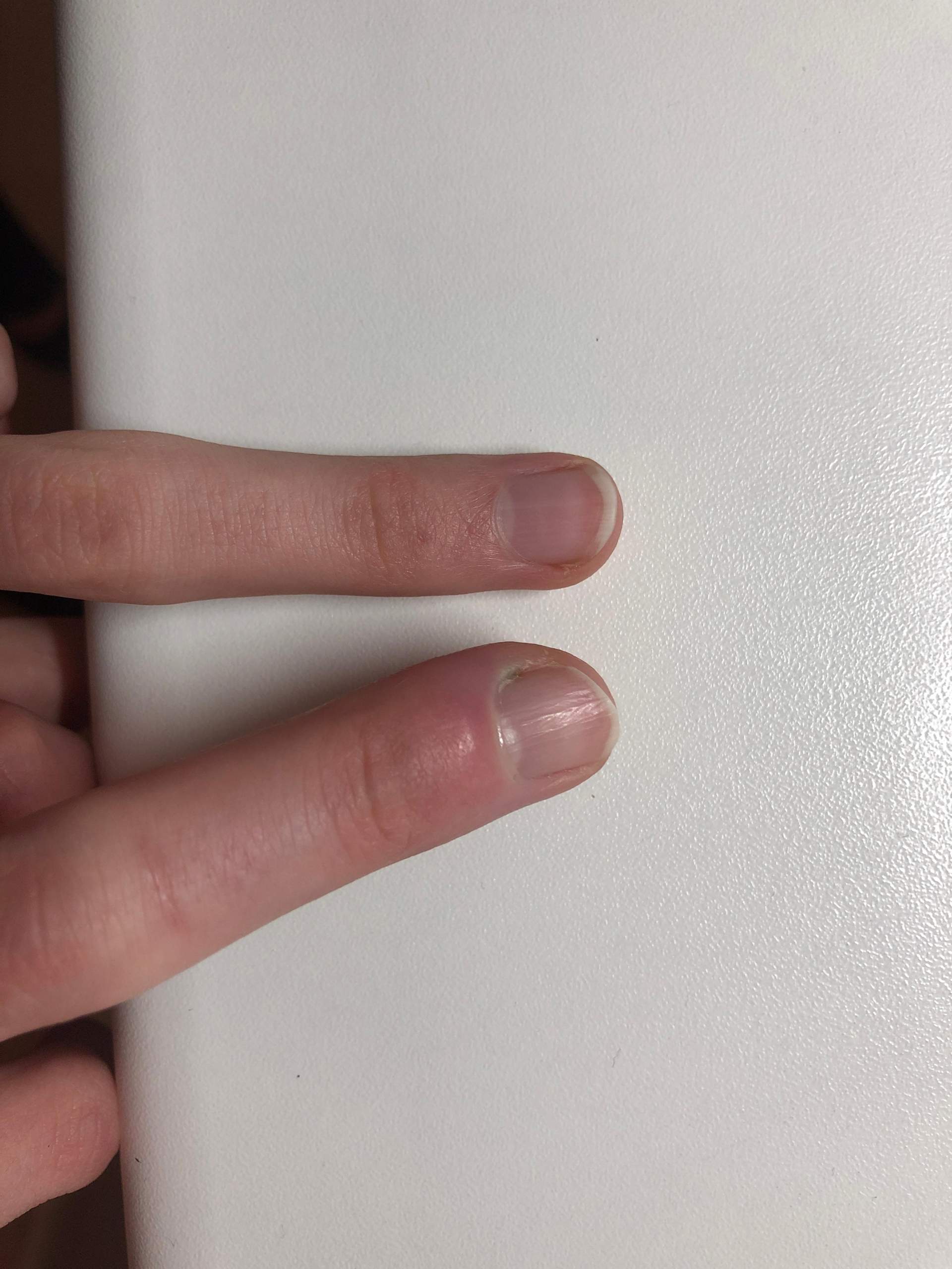 Finger ganz dick und rot-blau, was tun? (Gesundheit und Medizin