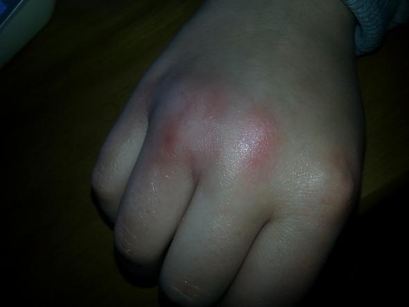 Finger Gebrochen Oder Etwas Harmloses