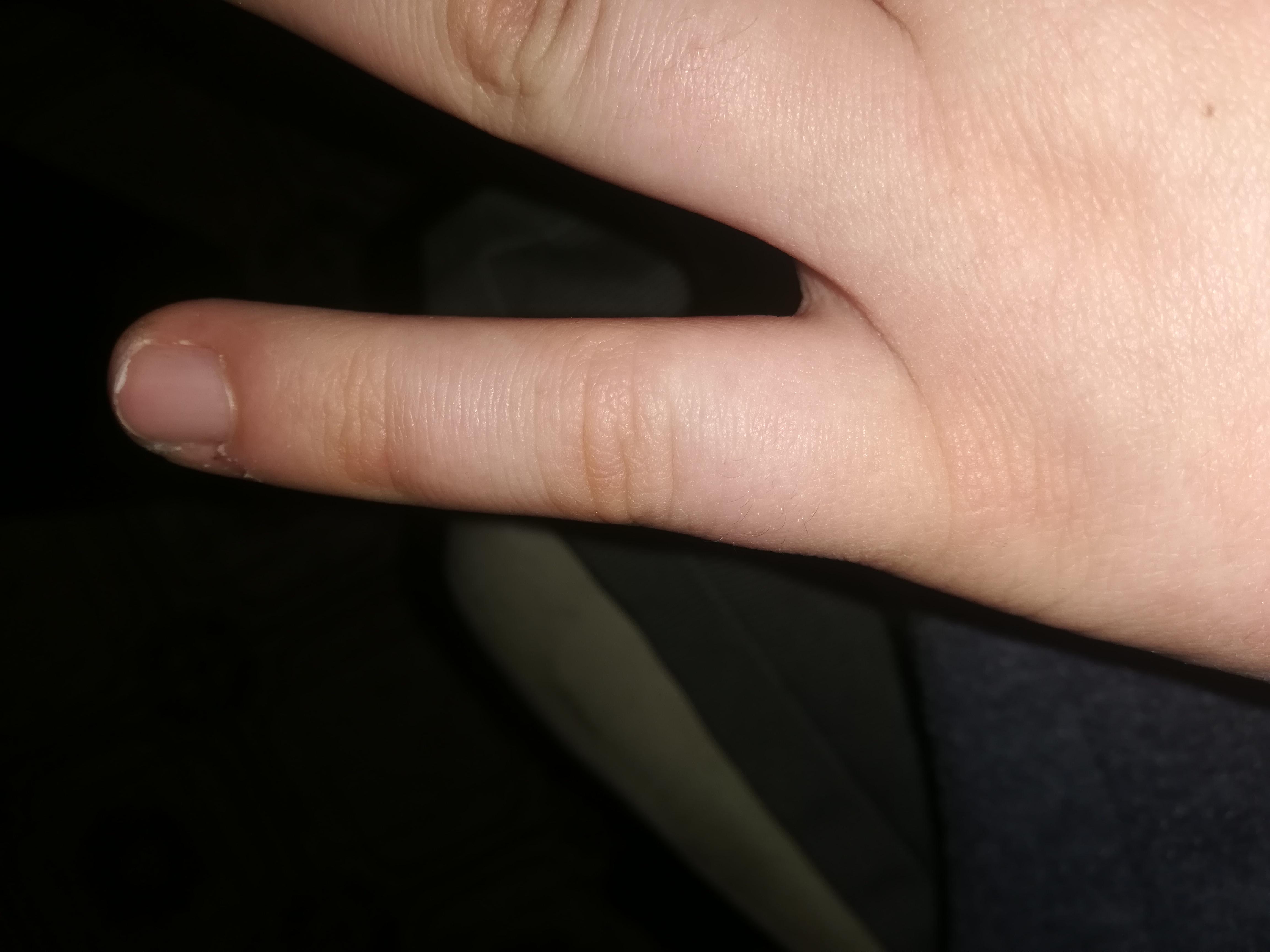 Finger Gebrochen Oder Noch Nichr Bruch Finger Gebrochen Oder Noch Nichr Bruch