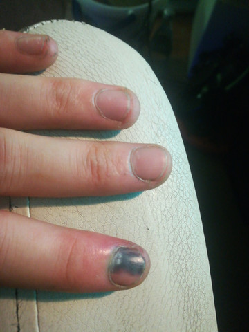 Finger Geklemmt Verliere Ich Meinen Fingernagel Oder Muss Ich Zum Arzt Gesundheit Und Medizin Gesundheit Schmerzen Finger Geklemmt Verliere Ich Meinen Fingernagel Oder Muss Ich Zum Arzt Gesundheit Und Medizin Gesundheit Schmerzen
