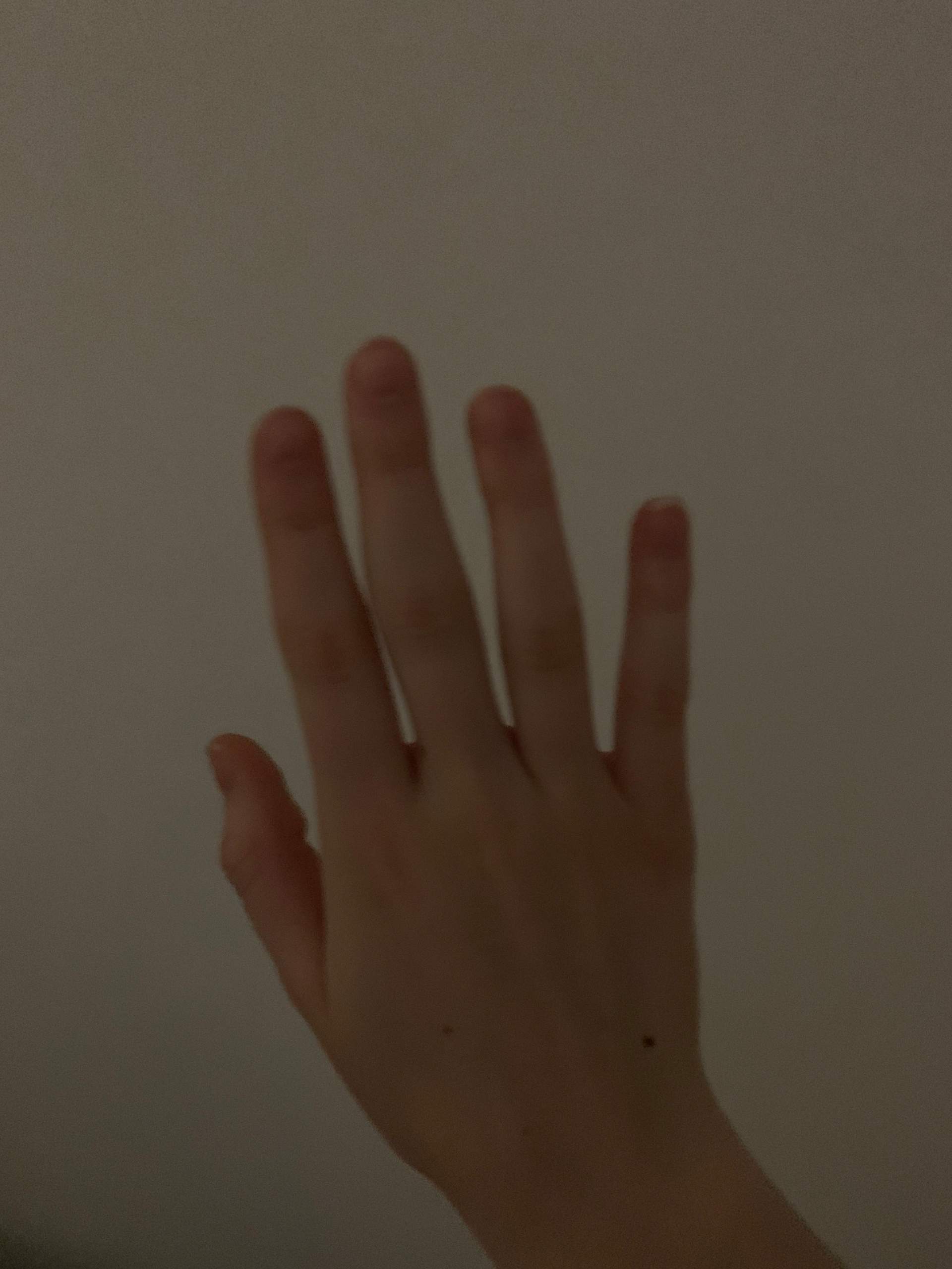 Finger geprellt/verstaucht/gebrochen? (Gesundheit und Medizin, Verletzung, Prellung)