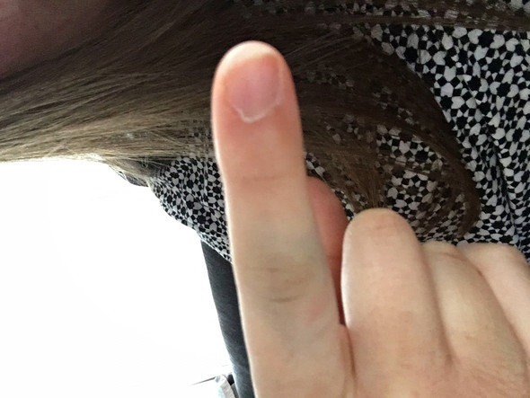 Finger Gequetscht Soll Ich Zum Arzt Quetschung Finger Gequetscht Soll Ich Zum Arzt Quetschung