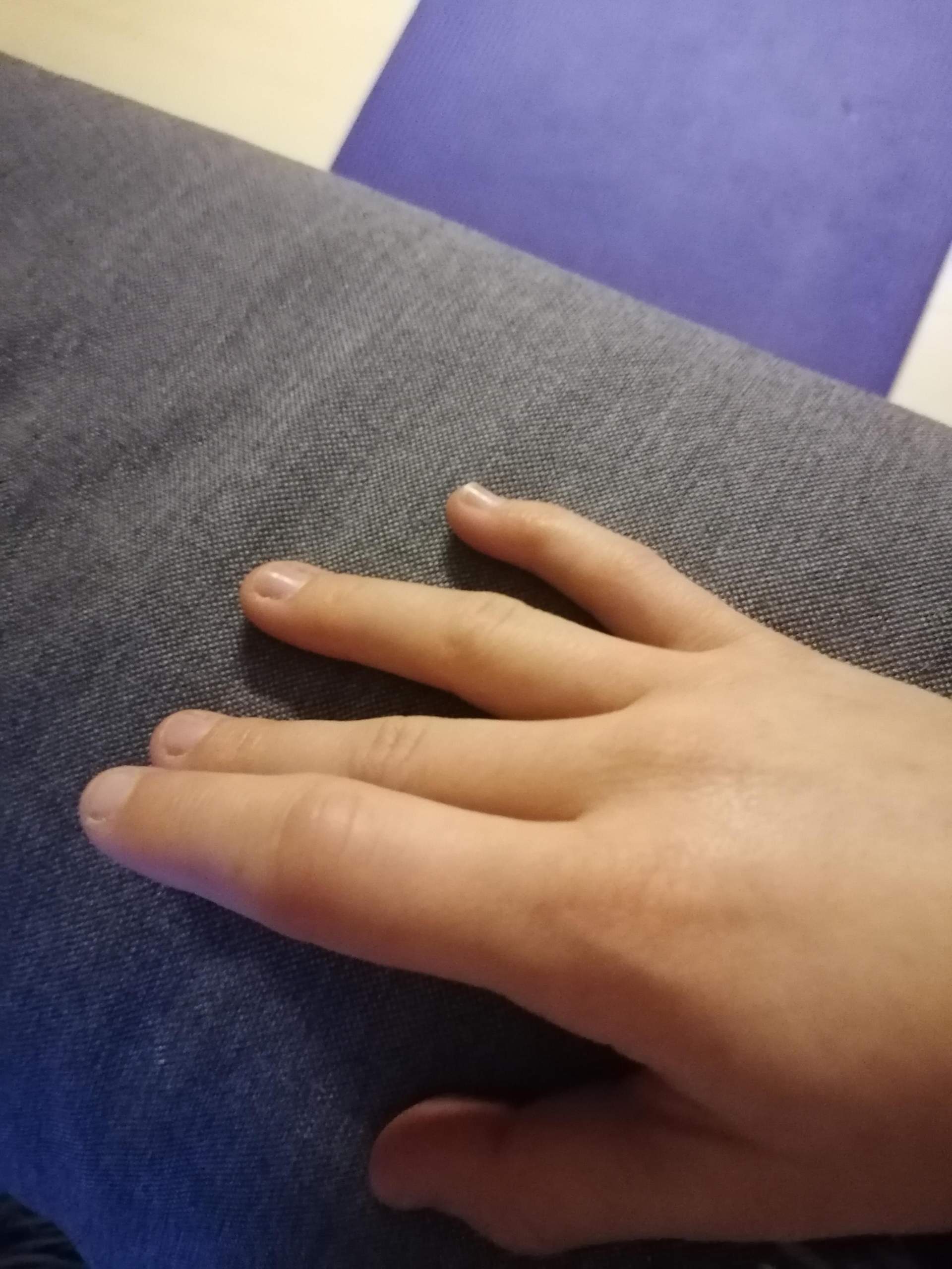 Finger Blau Geschwollen Aber Beweglich