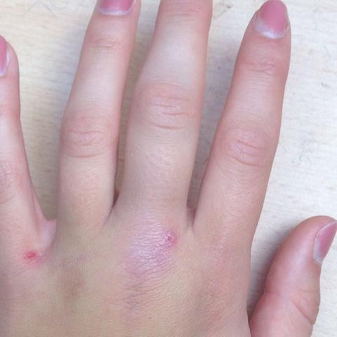 Mittelfinger - (Hand, Finger, kapseln)