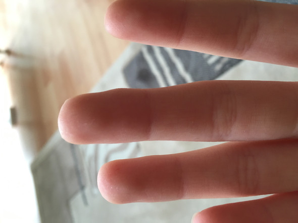 Finger geschwollen ohne Schmerzen?