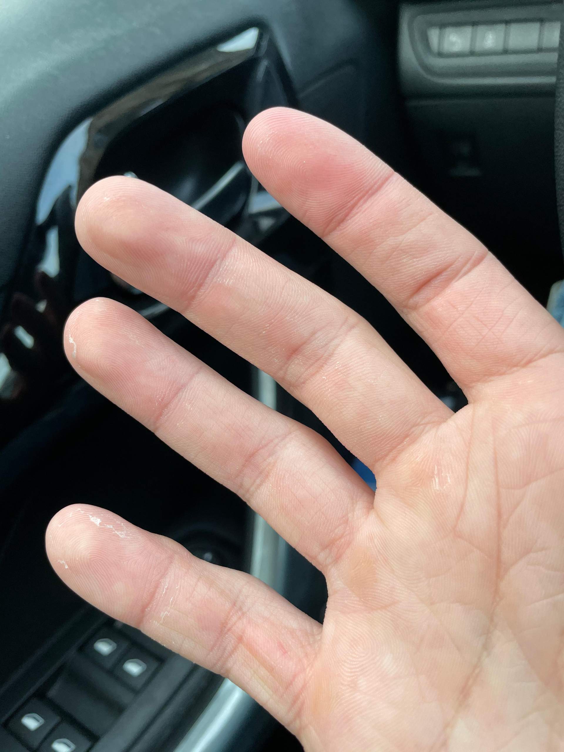 Finger Haut löst sich, was ist das? (Gesundheit und Medizin, Pflege, Hautarzt)
