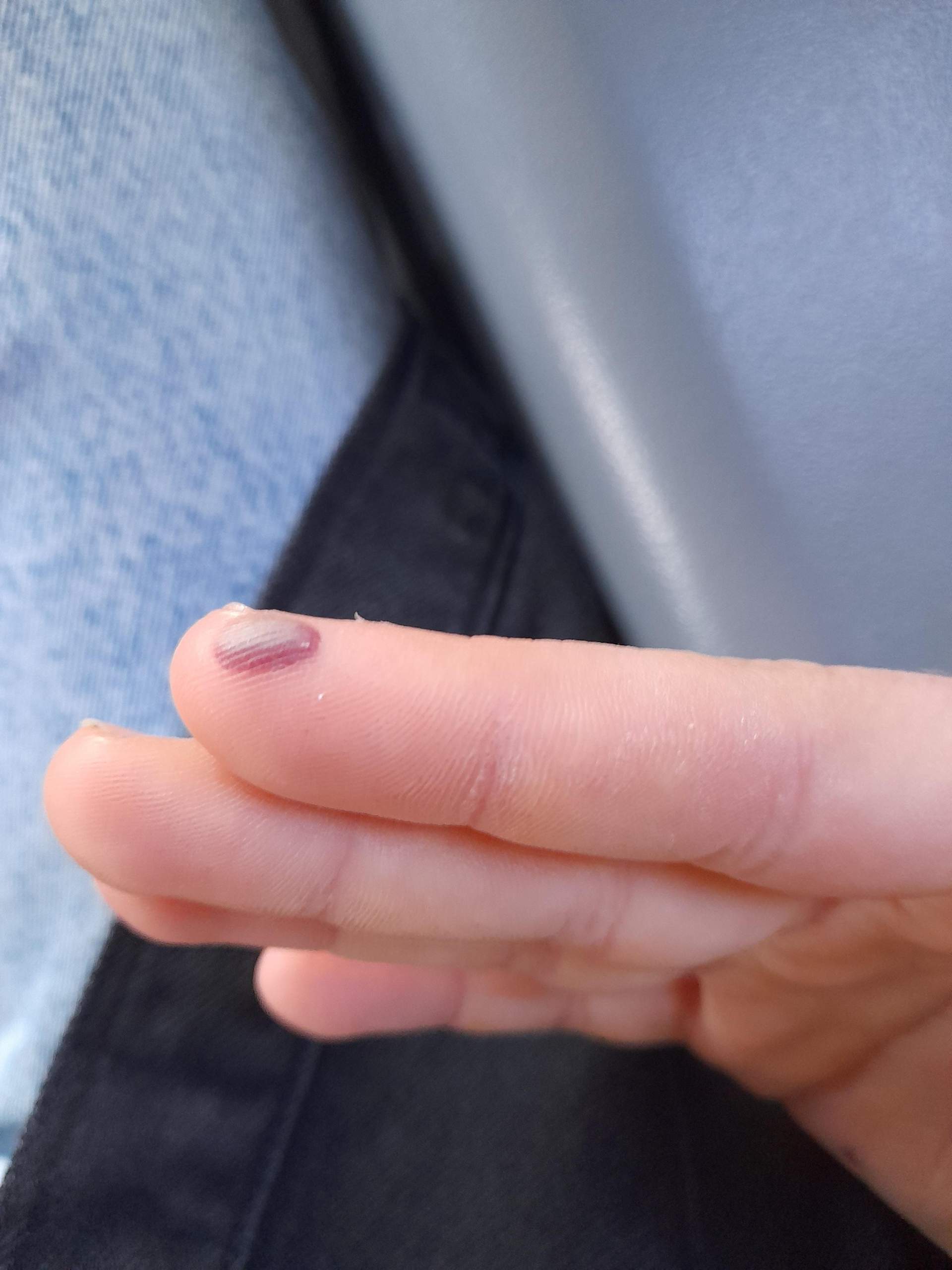 Finger in der Tür eingeklemmt?