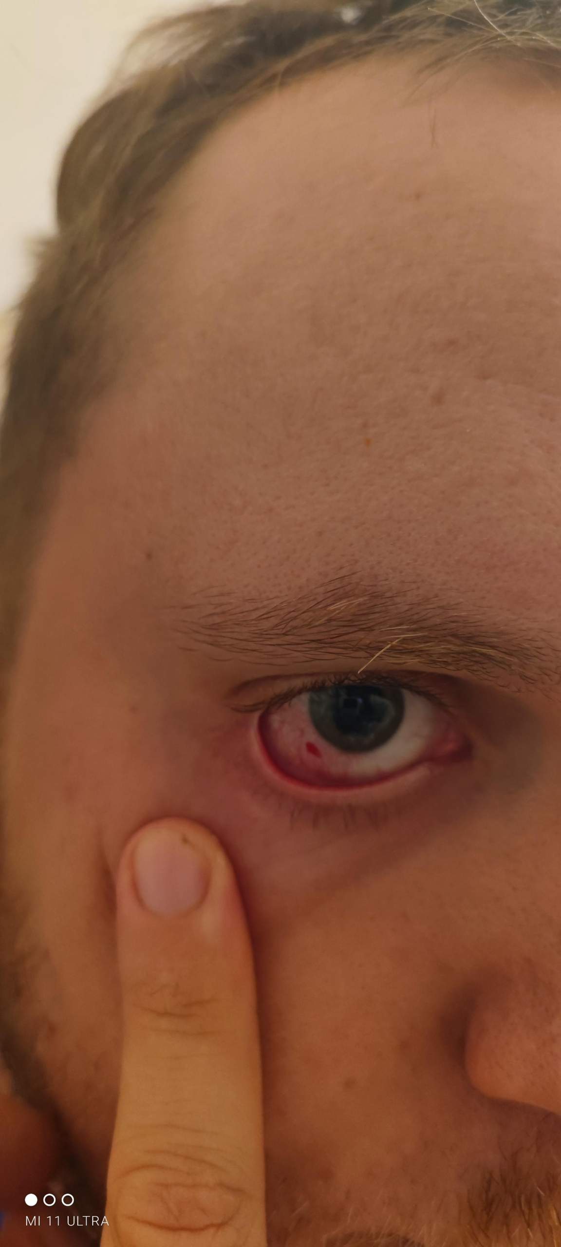 Finger Ins Auge Gestochen Was Tun