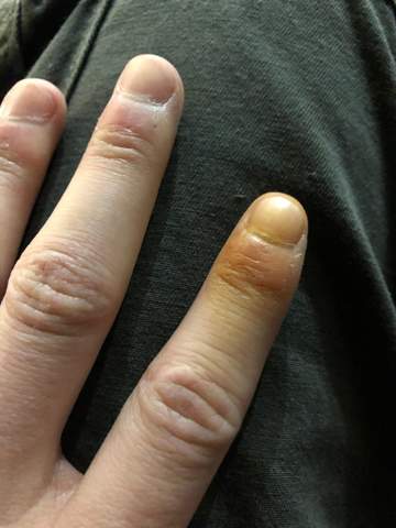 Finger ist Gelb , was kann es sein?