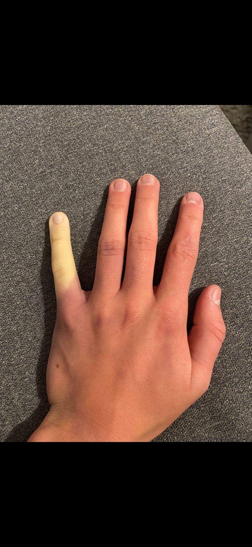 Finger ist weiß? (Gesundheit und Medizin, Gesundheit, Medizin) Finger ist weiß? (Gesundheit und Medizin, Gesundheit, Medizin)
