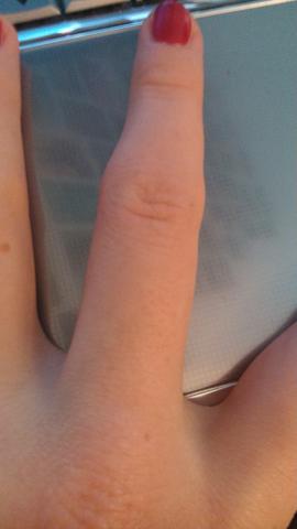 Wie lange verstaucht geschwollen finger Finger ausgekugelt