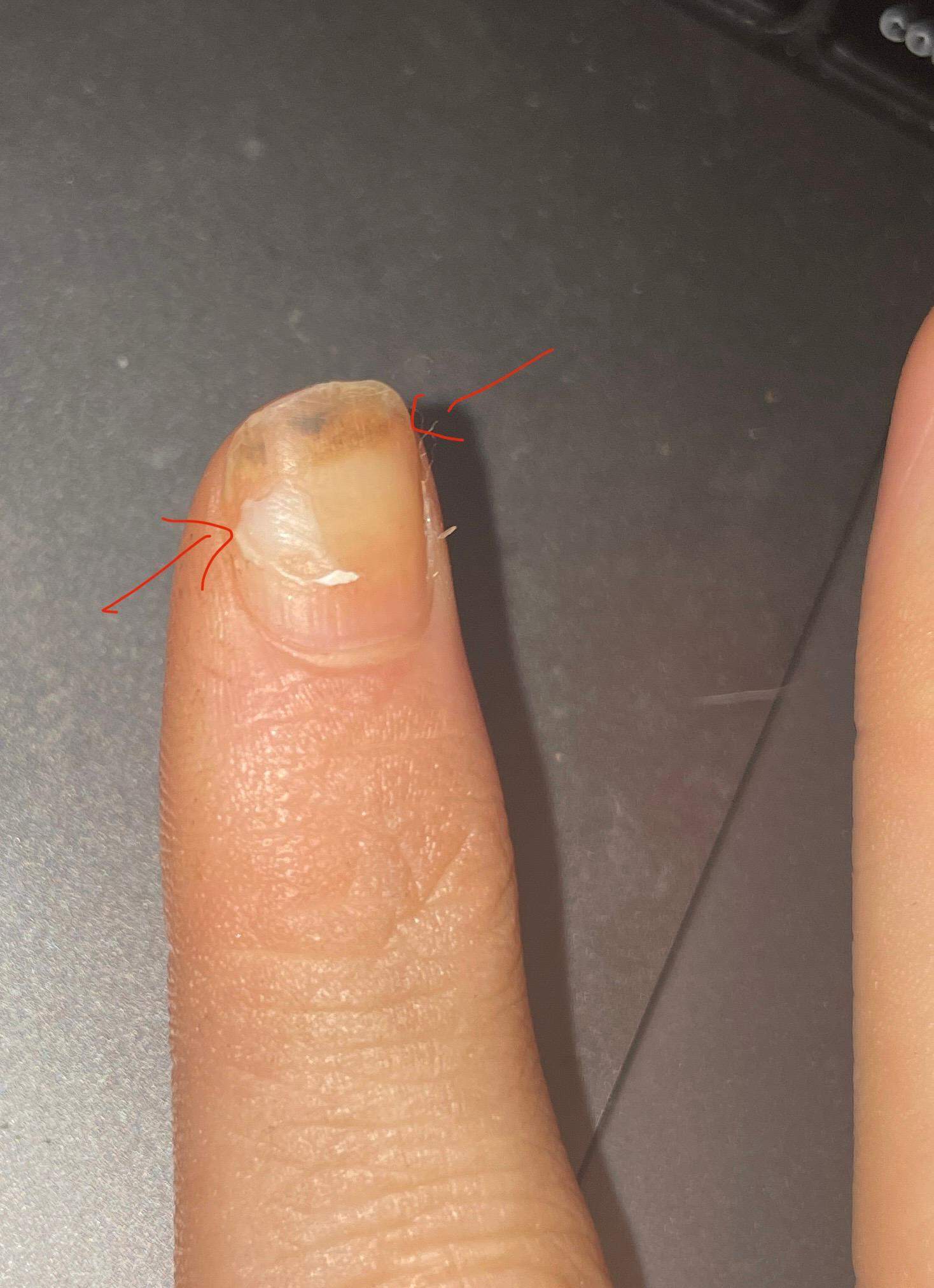 Finger Nägel löst sich immer weiter vom Nagelbett? (Gesundheit und Medizin, Arzt, Beauty) Finger Nägel löst sich immer weiter vom Nagelbett? (Gesundheit und Medizin, Arzt, Beauty)