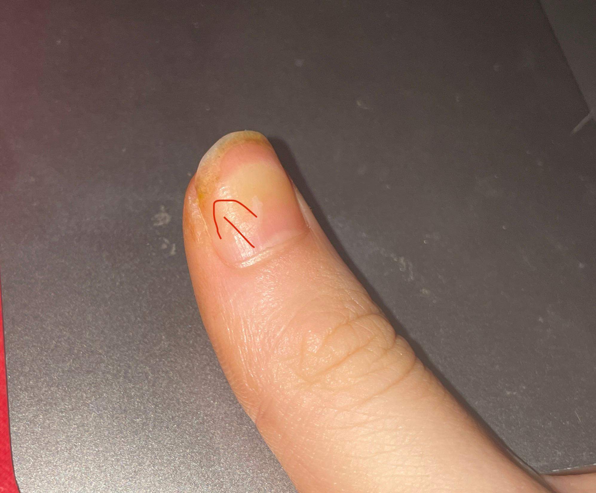 Unter Zehennagel wächst neuer Zehennagel? (Gesundheit, Medizin, Körper) Unter Zehennagel wächst neuer Zehennagel? (Gesundheit, Medizin, Körper)