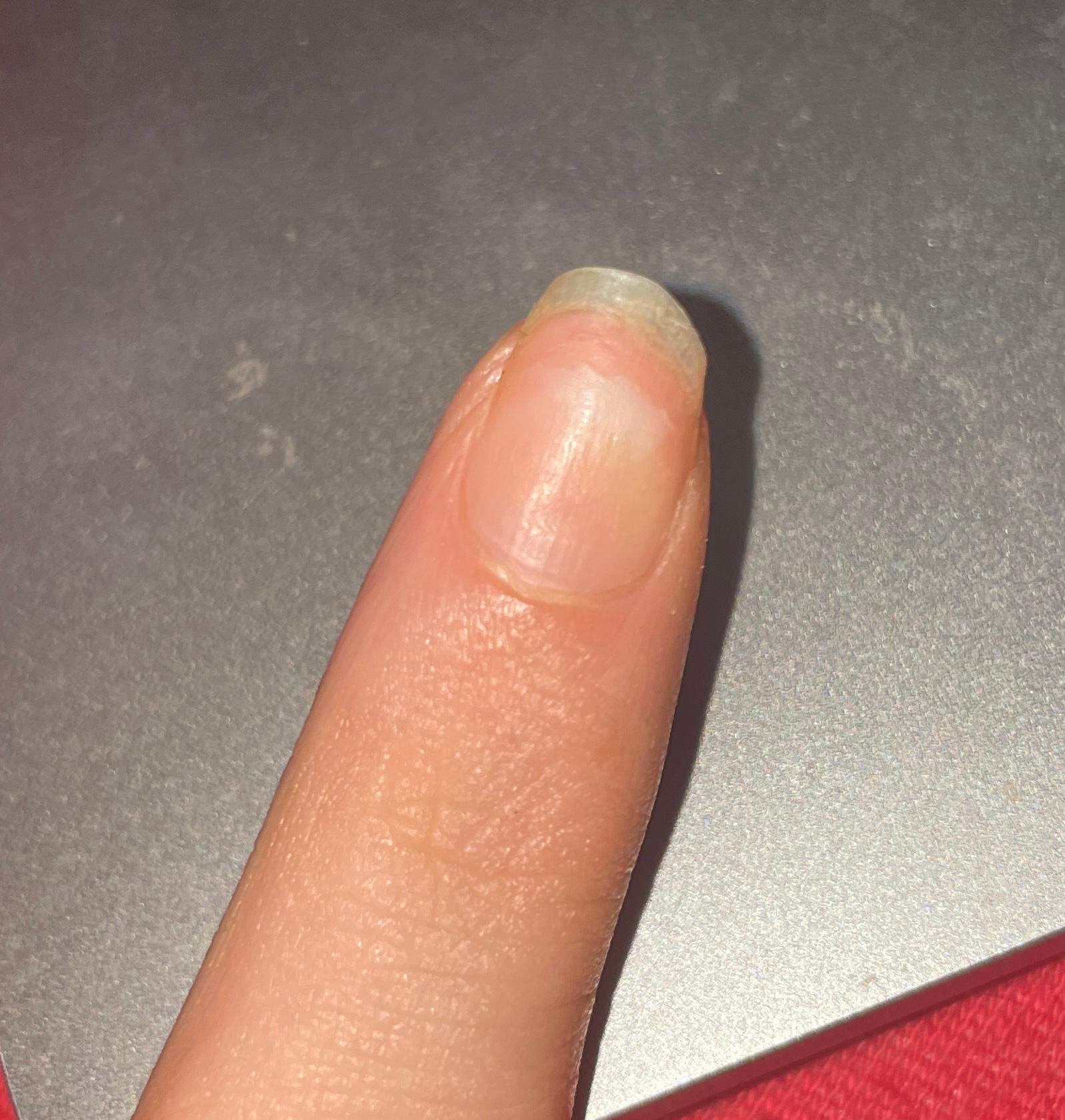 Finger Nägel löst sich immer weiter vom Nagelbett? (Gesundheit und Medizin, Arzt, Beauty) Finger Nägel löst sich immer weiter vom Nagelbett? (Gesundheit und Medizin, Arzt, Beauty)