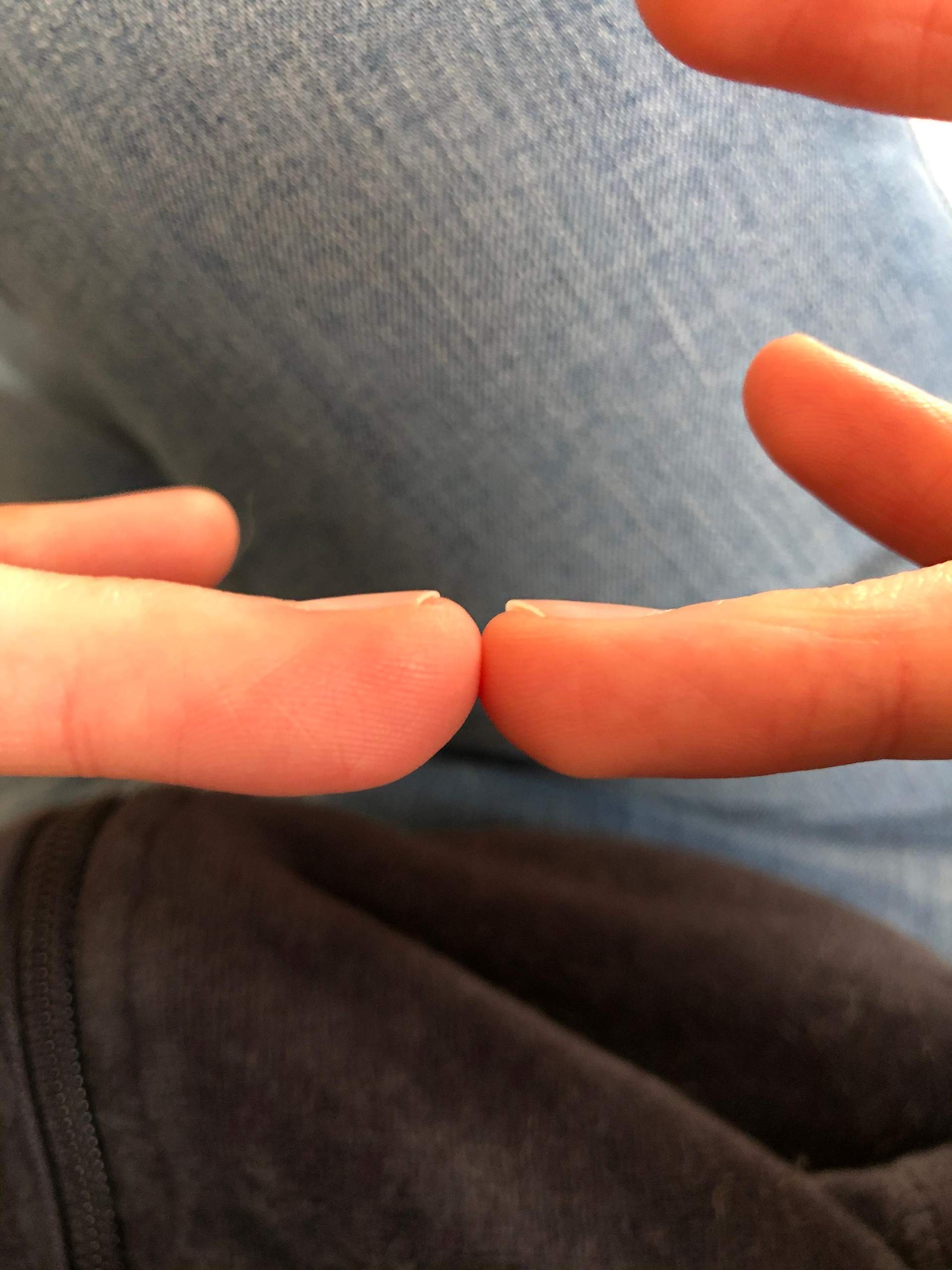 Finger plötzlich geschwollen - was tun? (Gesundheit und Medizin, Haut