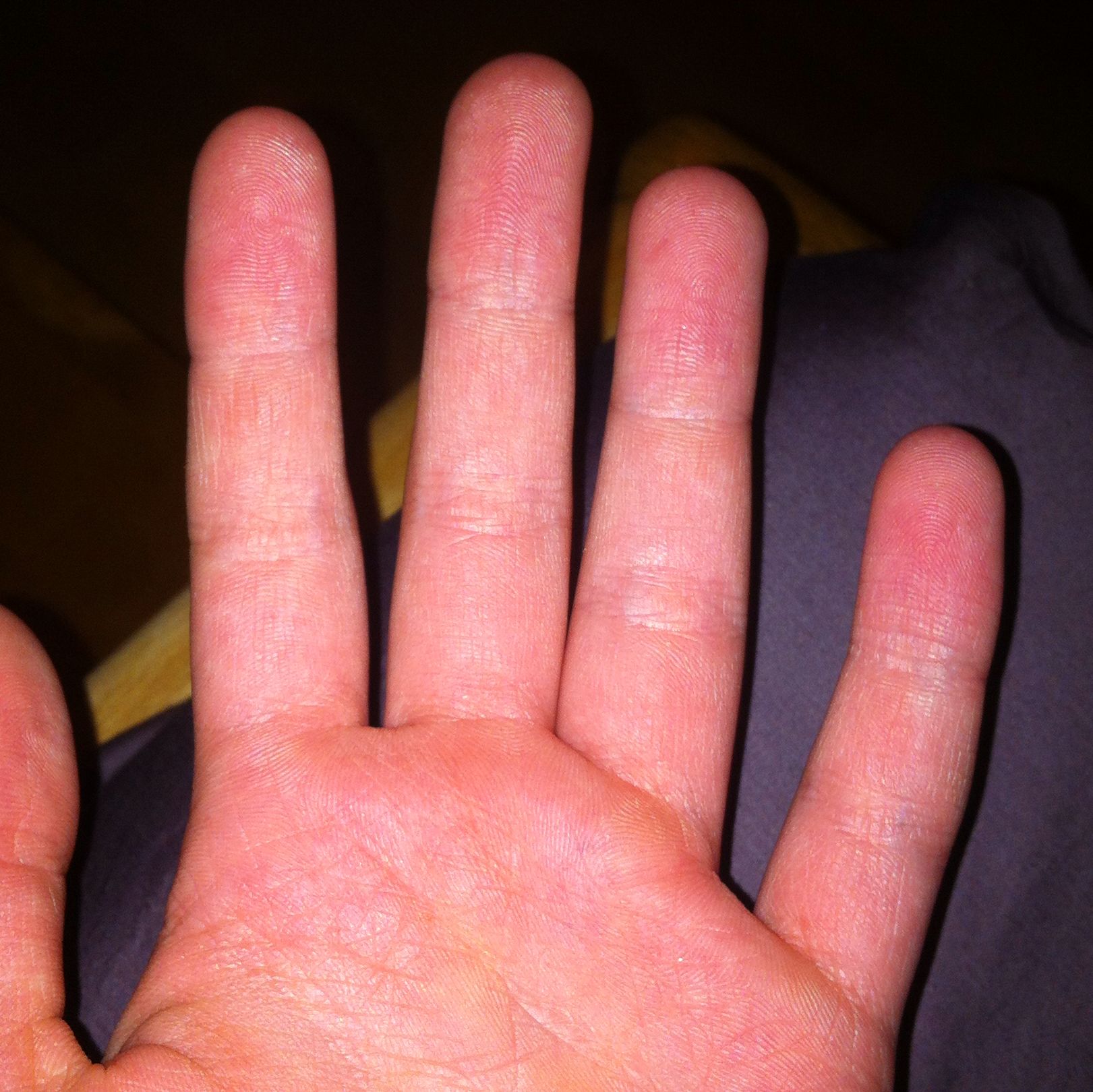 Finger sind angeschwollen nach spazieren gehen (fett)